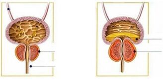 Tipos e formas de prostatite nos homes