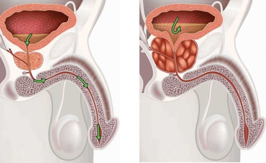 glándula prostática sa e inflamada