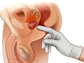 Masaxe de próstata para o tratamento da prostatite nos homes