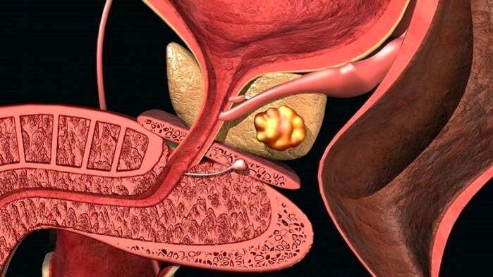 Depósitos de pedra na próstata con prostatite calculosa