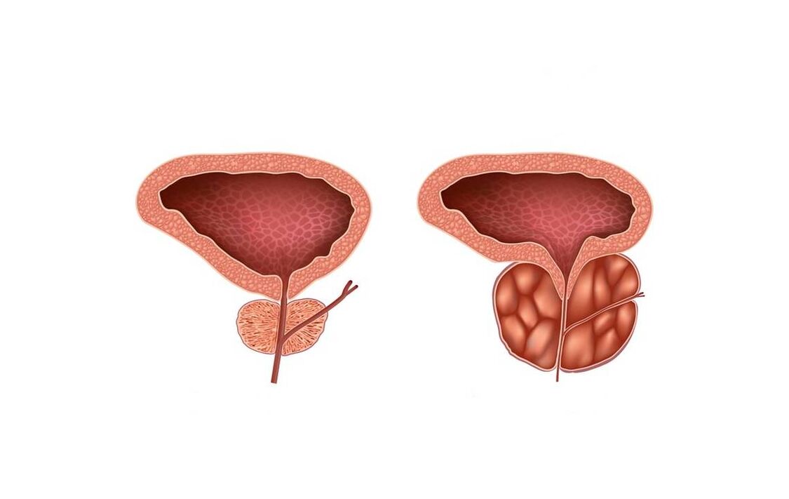 síntomas de prostatite nos homes