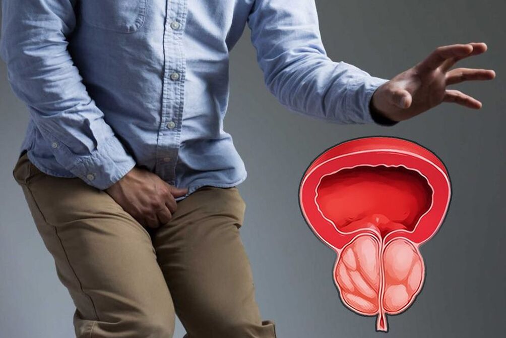 próstata aguda en homes
