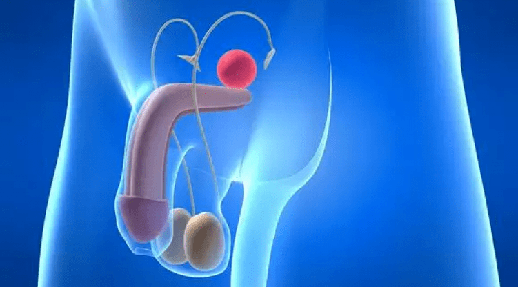 A prostatite é unha inflamación da glándula prostática nos homes, que require un tratamento complexo